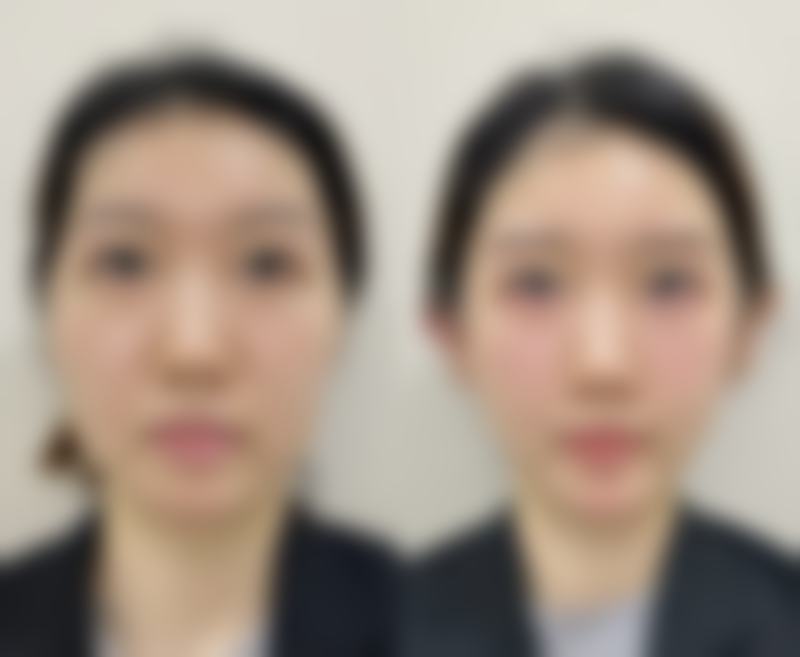 四、骨骼结构变化导致的眼袋大