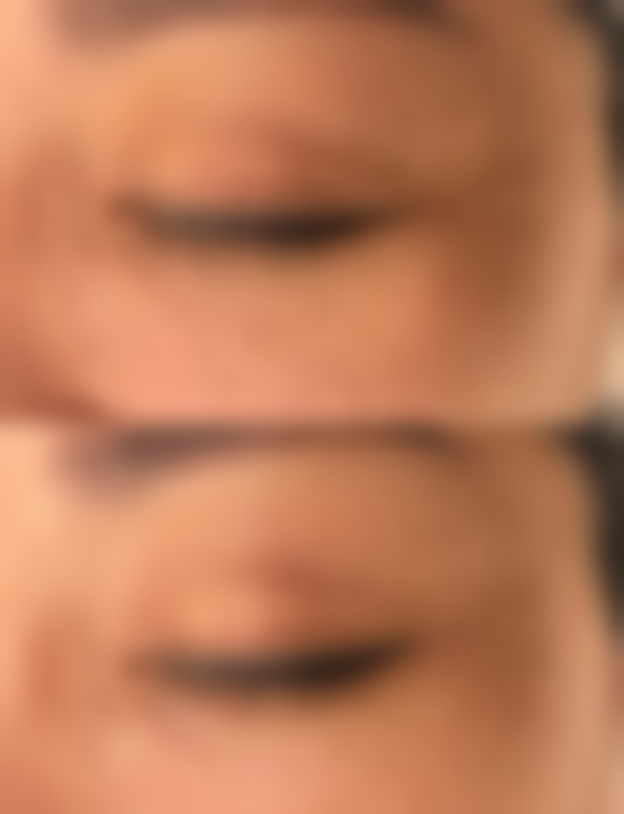 三、全切与埋线法的成效对比