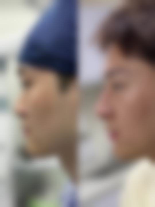 一、隆鼻取耳软骨的常见后遗症