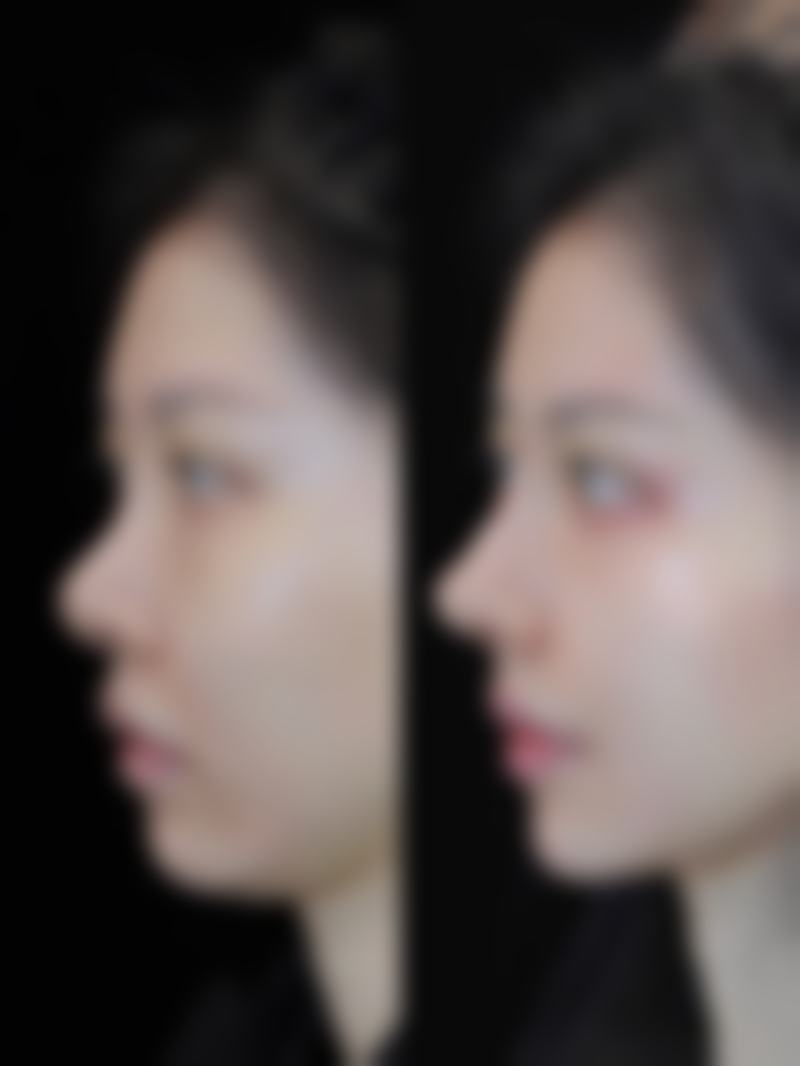 做双眼皮手术前应该注意什么？全面解析术前评估、身体准备及心理预期要点 