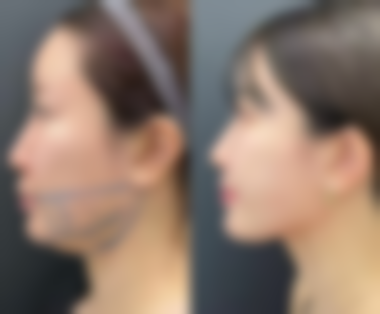 动手术留下的疤痕怎么治疗好？多种方法助力术后疤痕改善与修复！ 