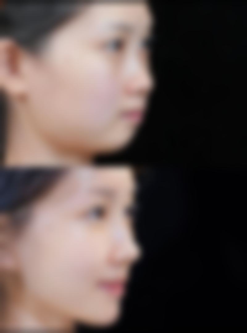 一、皮肤擦破后留疤的决定因素