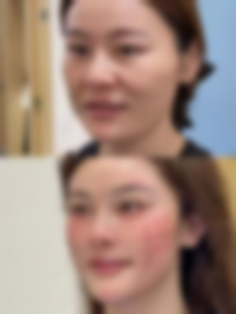 皮肤擦破了怎么处理才不留疤痕？掌握这些最快恢复方法让疤痕远离你！ 