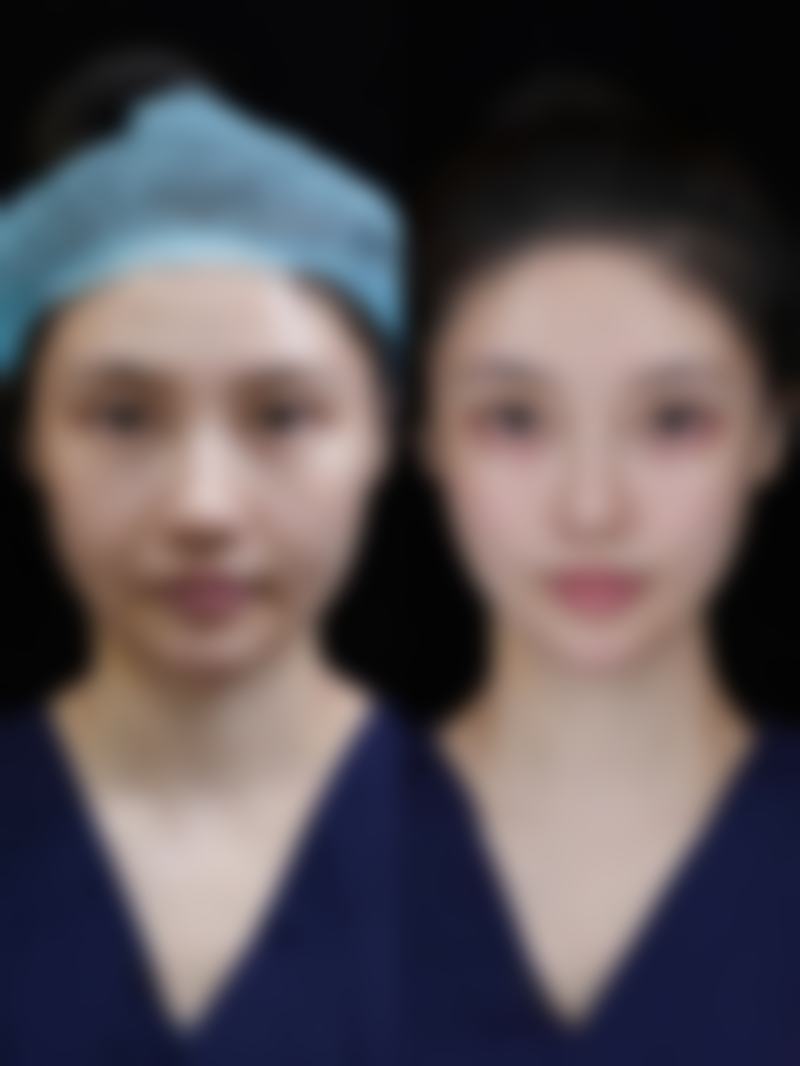五、水光针除皱的注意事项
