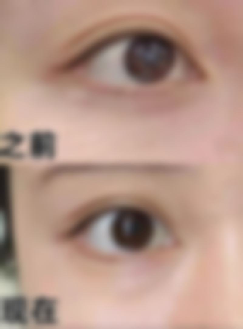 二、水光针对不同皱纹的作用