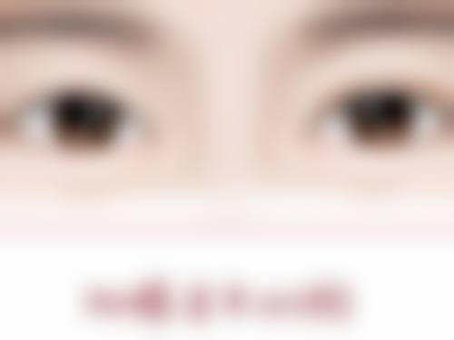 一、双眼皮提肌的线断裂概率及正常情况