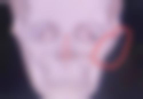 什么是眼综合双眼皮手术？常见项目、恢复要点及风险提示全揭秘！ 