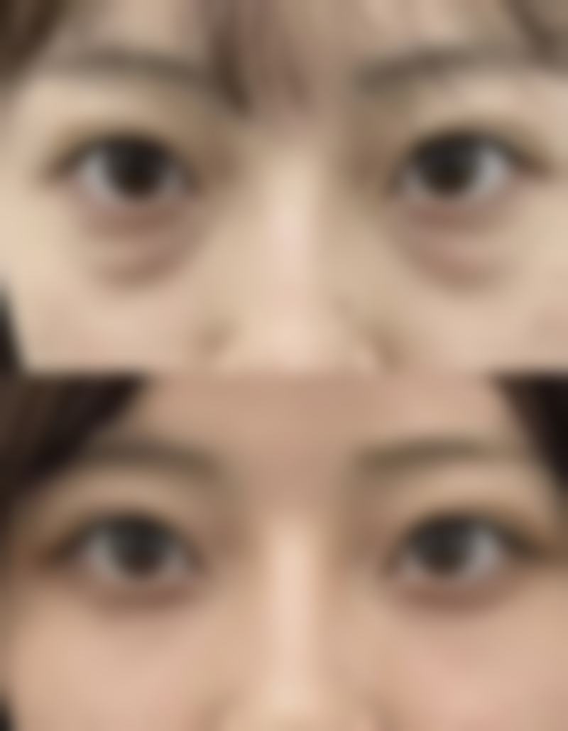 二、眼综合双眼皮手术常见项目