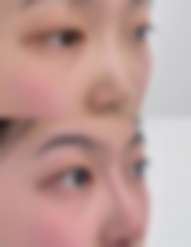 一、什么是眼综合双眼皮手术