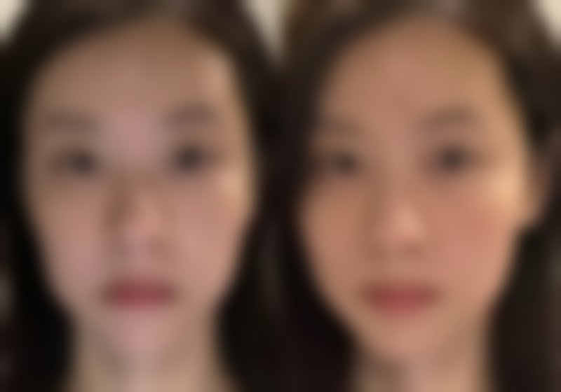 一、一般打瘦脸针打多少单位？常见剂量范围揭秘