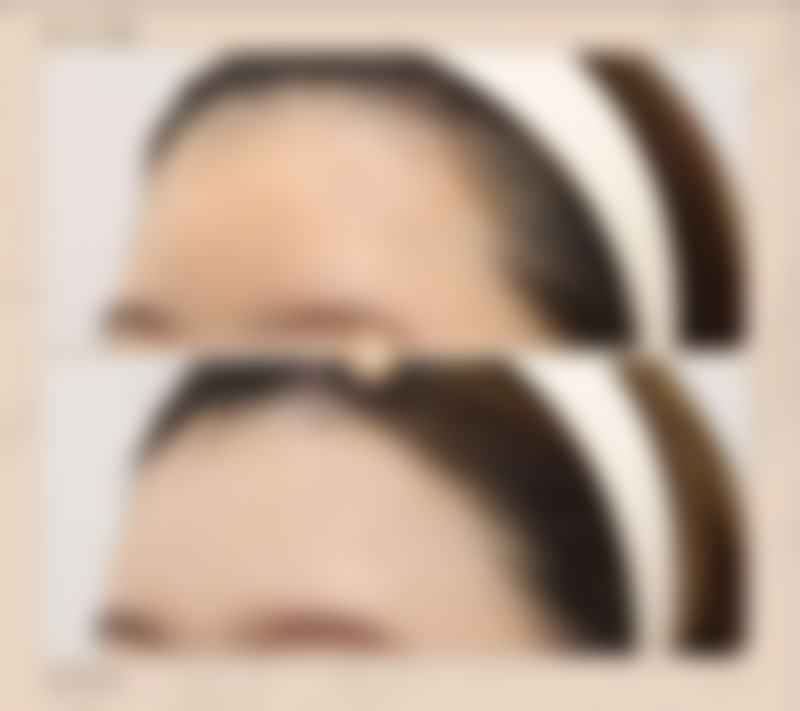 二、影响割双眼皮修复时间的因素