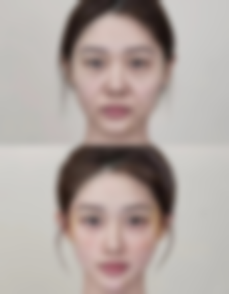 四、伤口的疤痕凸起来的护理要点