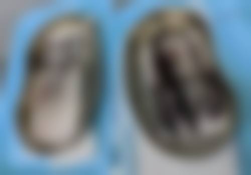 三、隆胸可以哺乳吗?两种隆胸方式对比