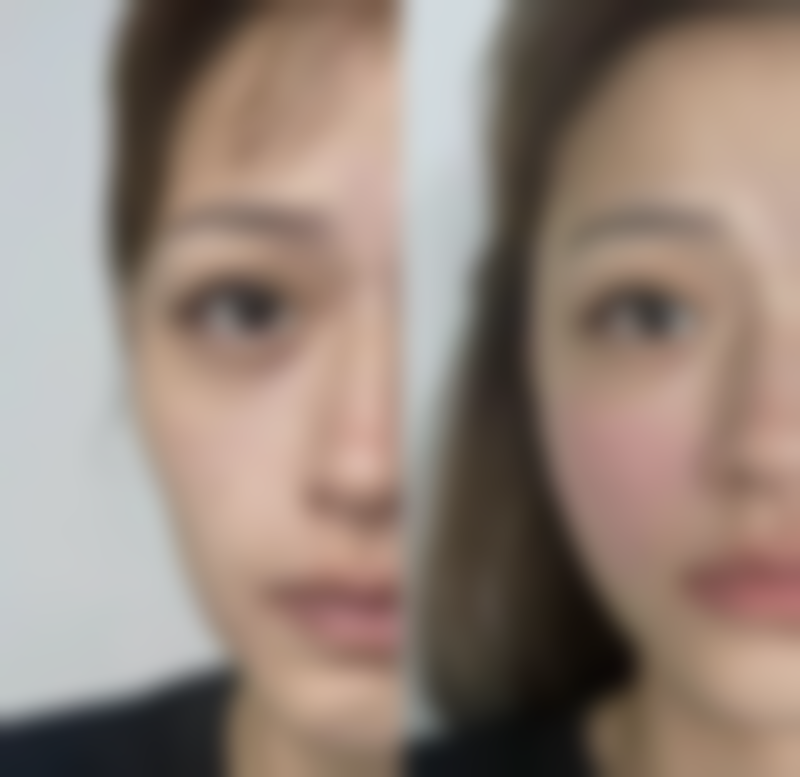 二、瘦脸针的危害有什么副作用 坏处之特殊情况