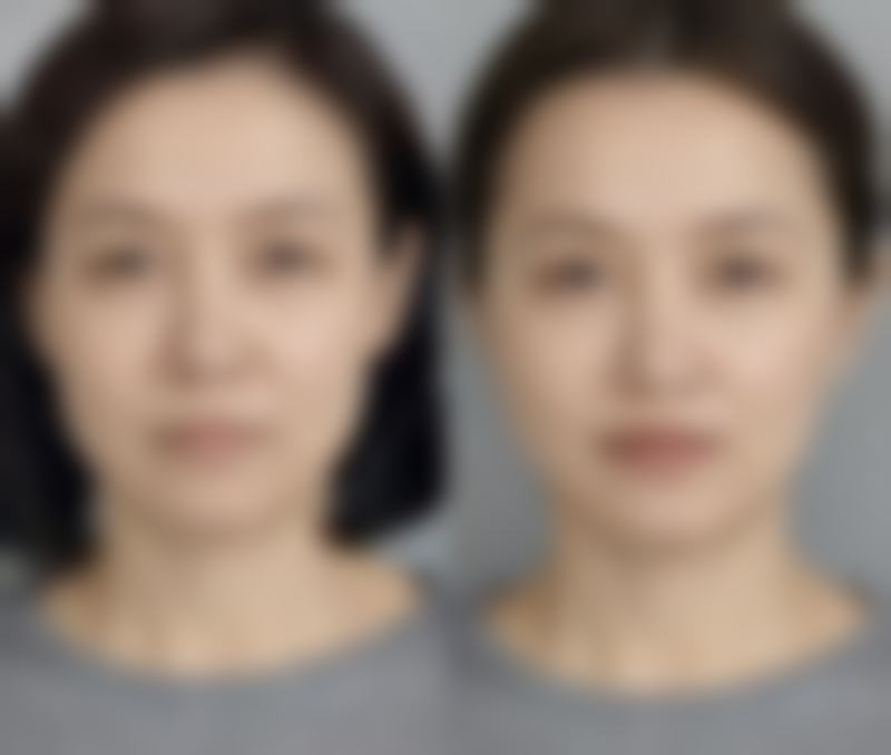 二、肉条感消失的大致时间