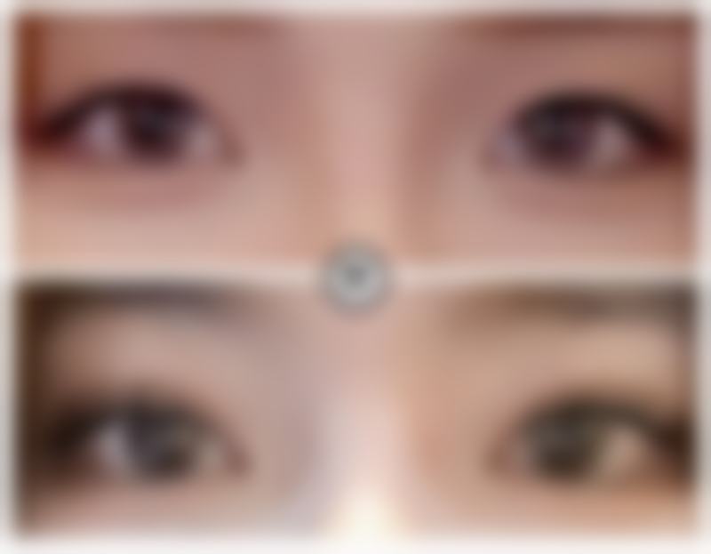 瘦脸针的危害有什么副作用 坏处？了解常见风险及应对方法助你安全变美！ 