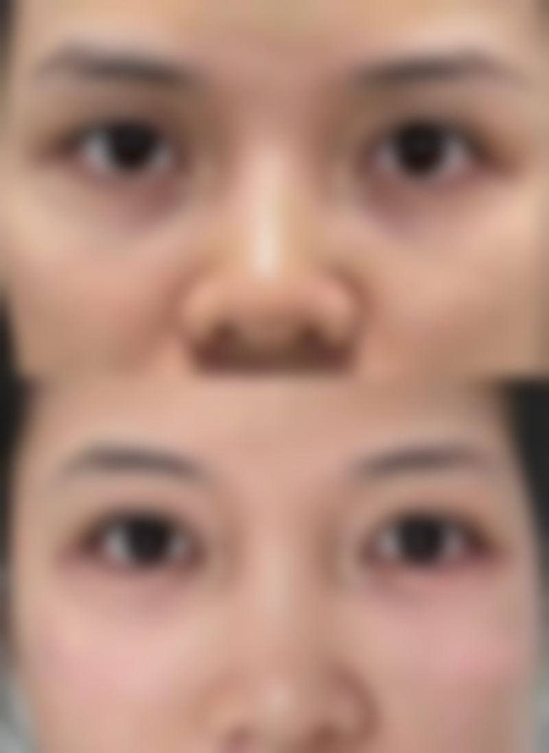 五、专精的医疗手段应对疤痕在增生