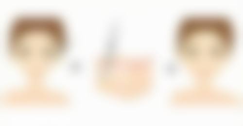 中年人如何去除眼袋总结