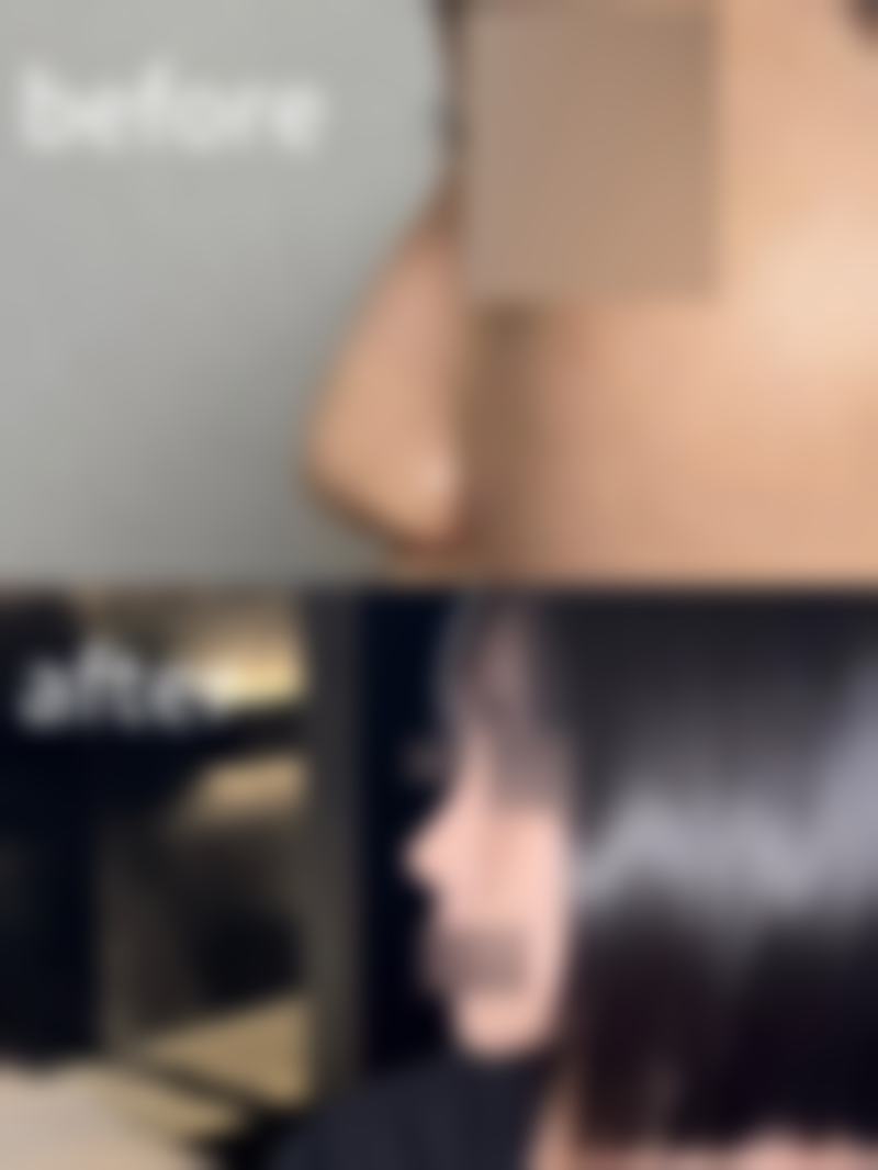 五、双眼皮术后的注意事项