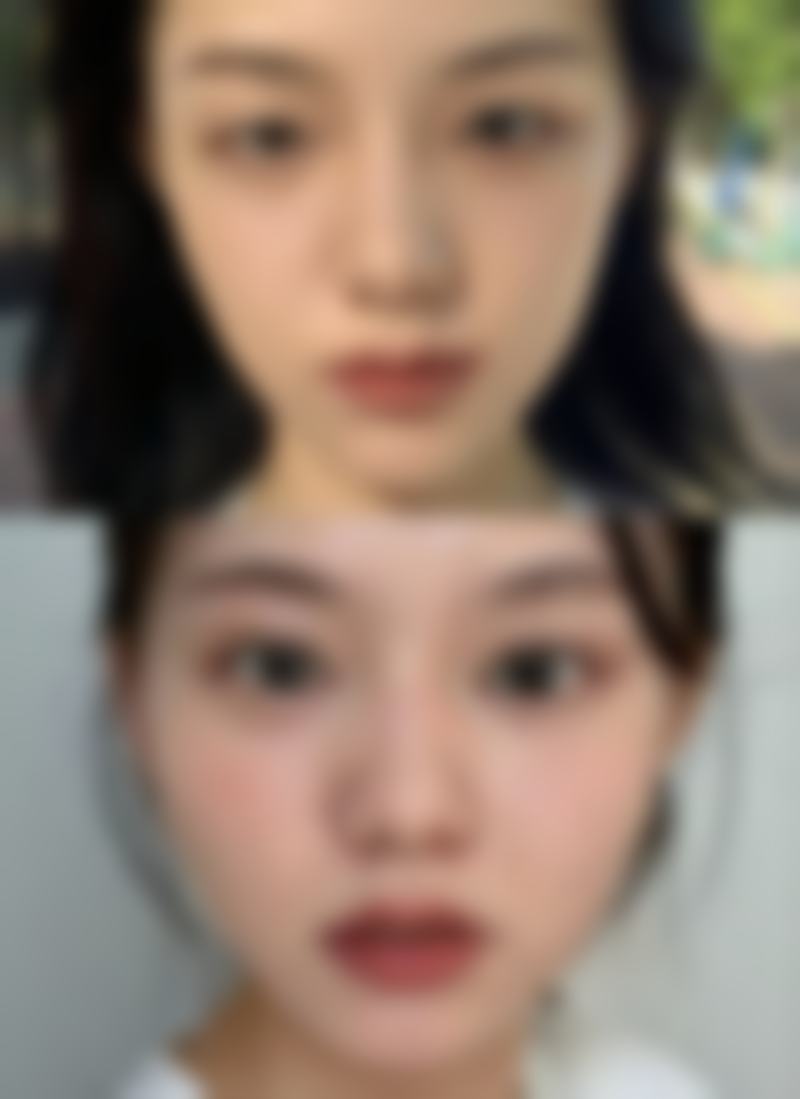 双眼皮白色疤痕怎么去除？掌握这些小妙招，让眼部疤痕轻松淡化消失！ 