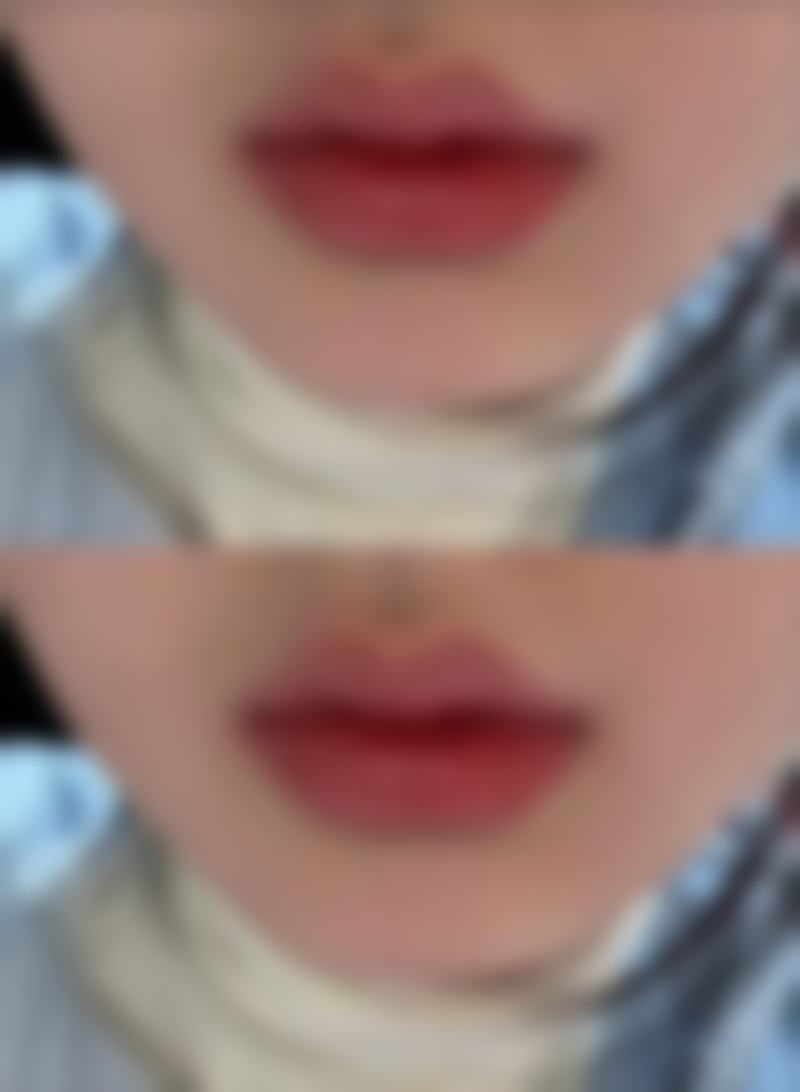 三、额头有疤痕该怎么办之不同疤痕类型的具体治疗方案