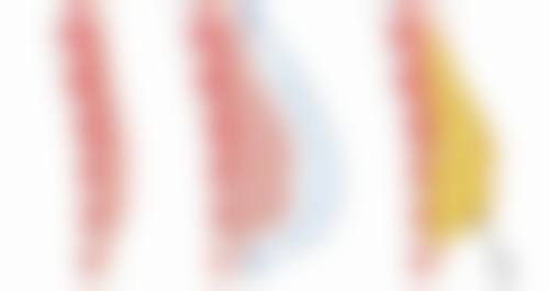 全切双眼皮用拆线吗?了解拆线详情并附图片示例，让你清晰知晓手术后续流程 