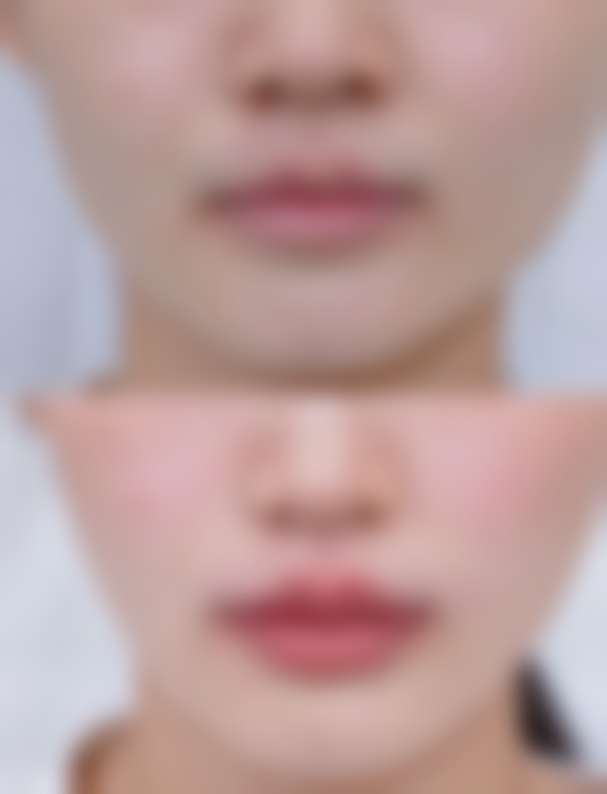 四、不同类型老疤痕的对应方案