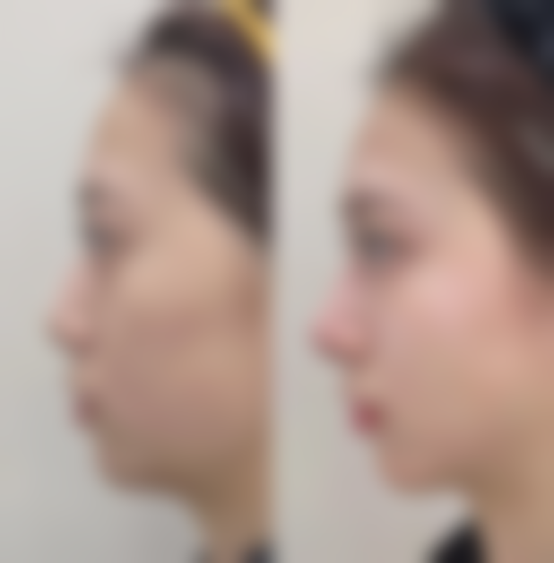 三、影响拆线时间的因素