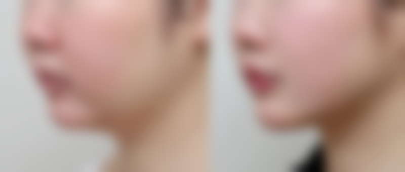 一、认识老疤痕