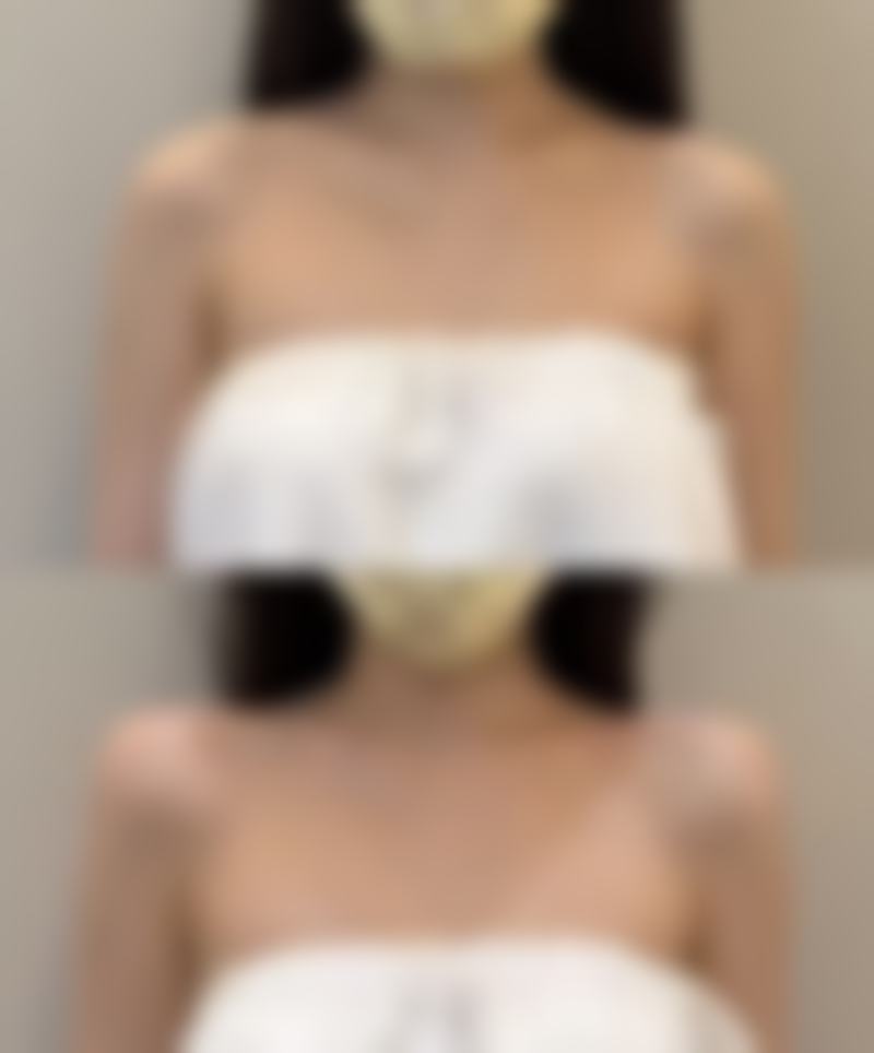 二、疤痕痘印的分型及特点