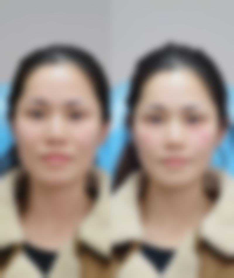 五、缝针后的疤痕修复注意事项