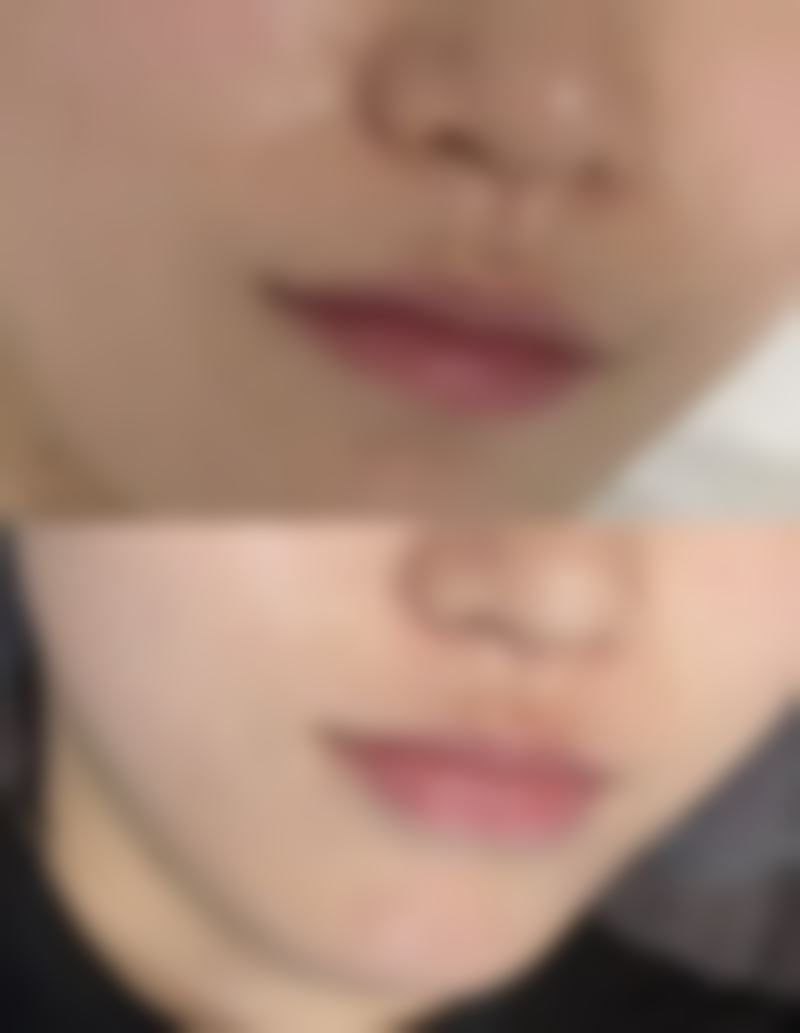 六、瘦脸针副作用会有哪些之总结