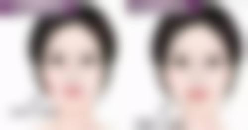 一、内切眼袋皮下淤血产生的原因