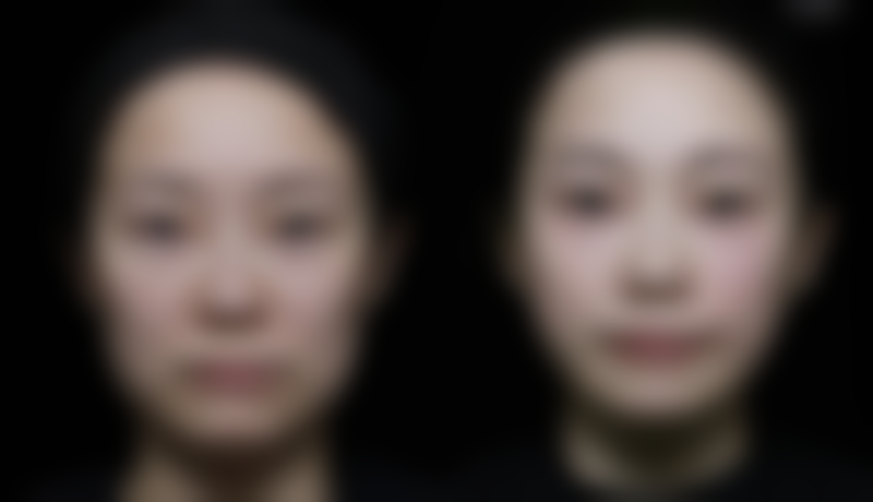 内切眼袋皮下的淤血怎么去除？分阶段护理、用药及注意事项全揭秘 