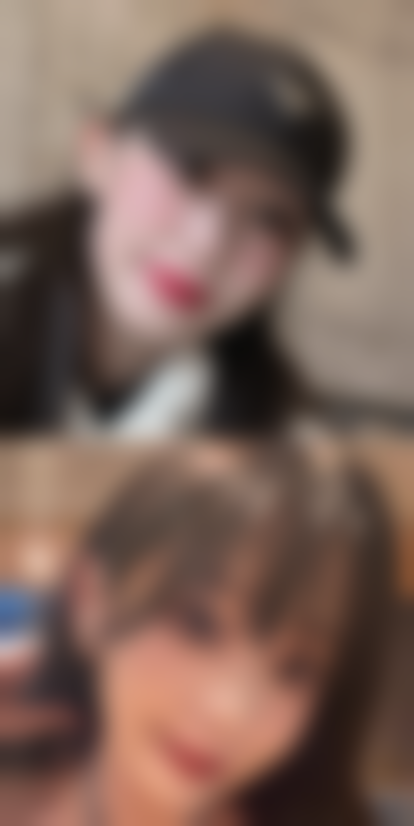 二、玻尿酸丰太阳穴鼓包的常见原因及应对办法