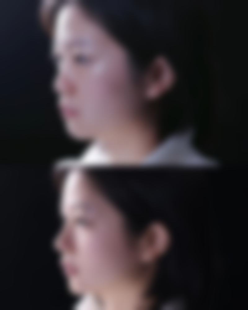 四、五十多岁女性抽脂的术后修复