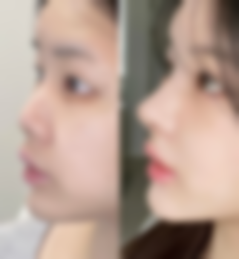 三、肚子吸脂皮会松吗?如何预防或改善松弛