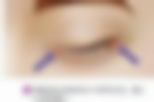 一、去眼袋可以保持多久之影响维持时间的关键因素