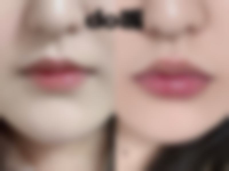 二、去眼袋可以保持多久之如何延长成效