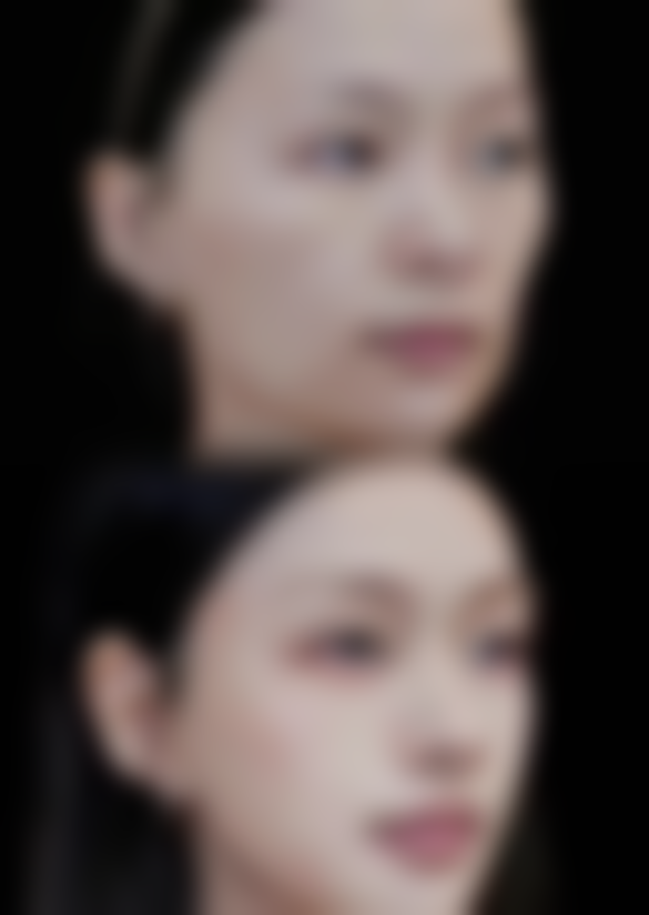 三、去眼袋可以保持多久之理性看待“反弹”