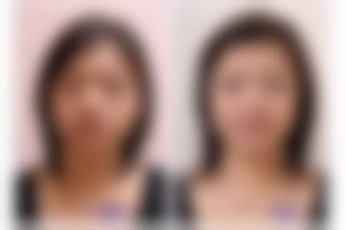 二、背部吸脂的短期副作用和危害