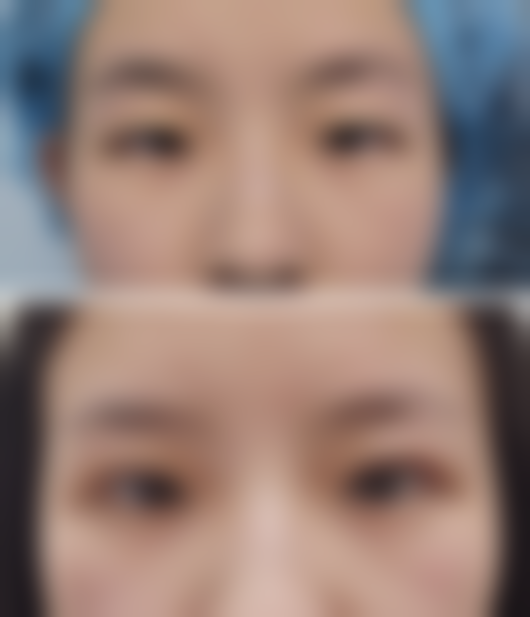 六、怎样去除疤痕黑印之注意事项