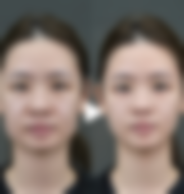 四、客观评估自然双眼皮的情况