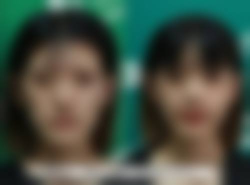 五、假体隆胸有一边硬的实例分析