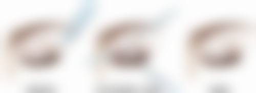 三、双眼皮提肌手术的术中操作