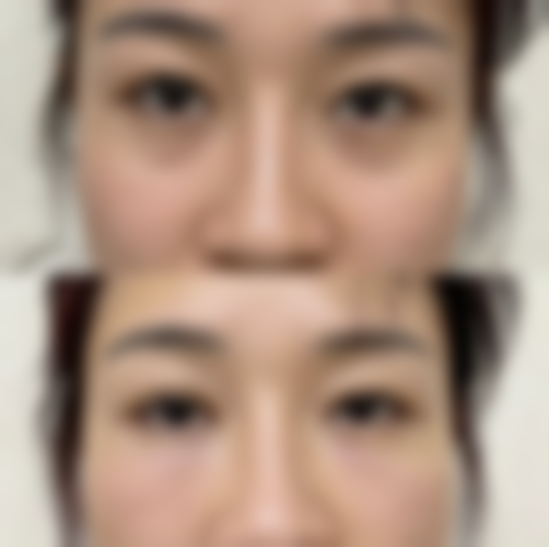 一、小型凹陷疤痕形成的原因