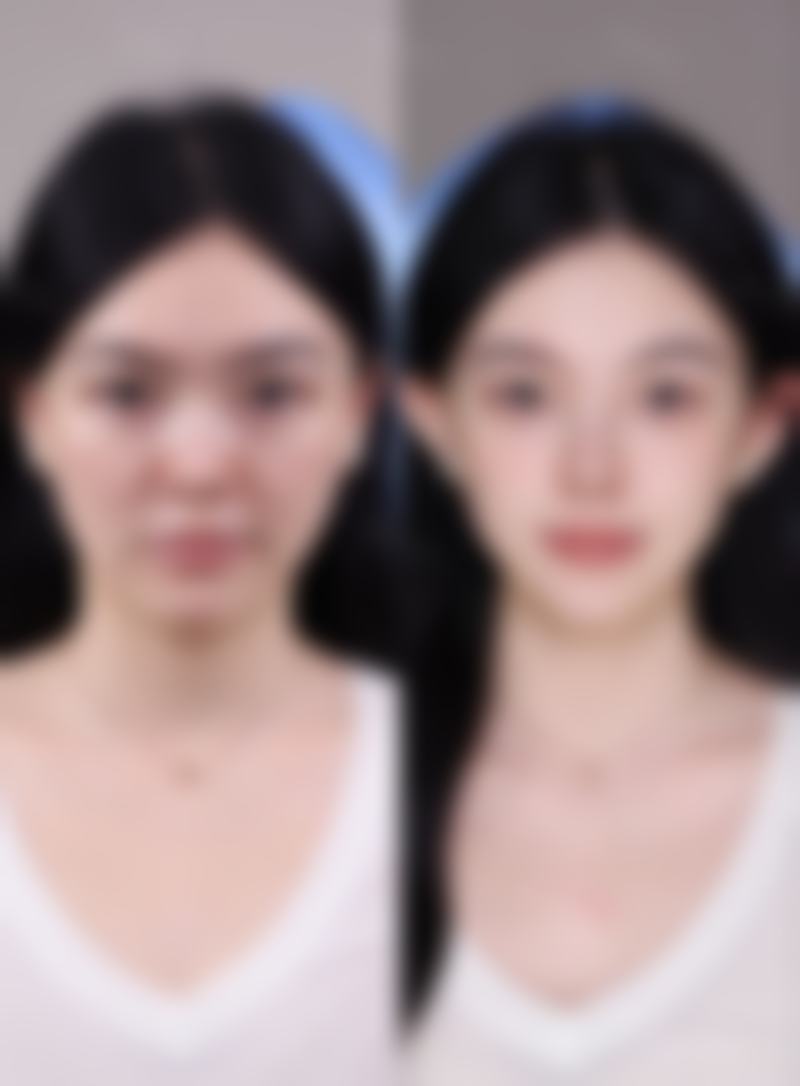 一、假体隆胸有一边硬的可能原因及评估