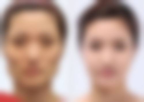 五、割双眼皮肉条的修复方案提示