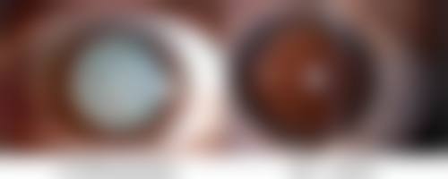 二、影响线提升隆鼻成效时长的关键因素