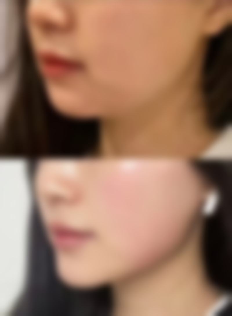 四、割双眼皮后护理与修复建议